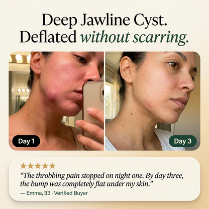Hormonal Acne Defense Concentrate™