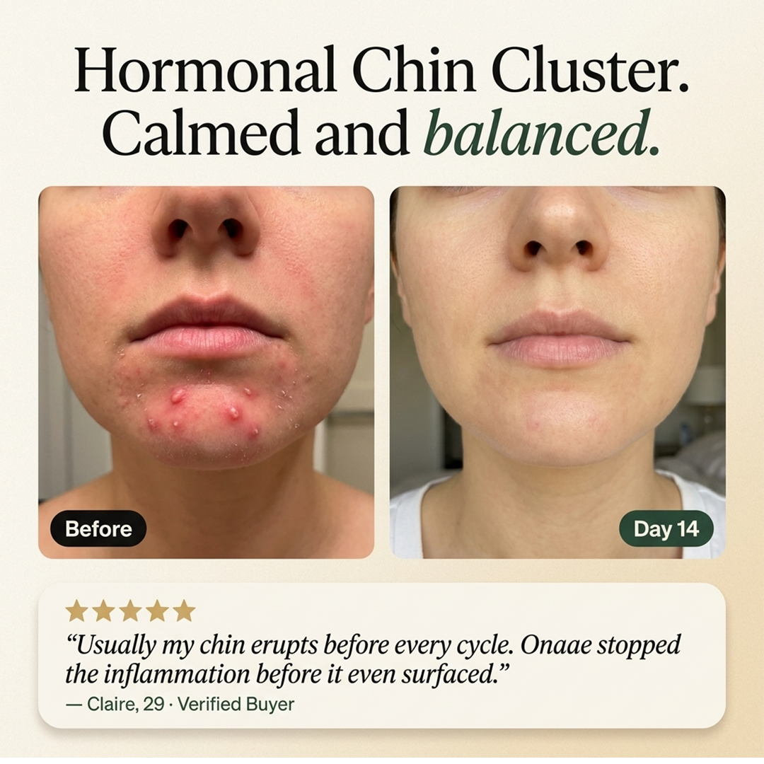 Hormonal Acne Defense Concentrate™