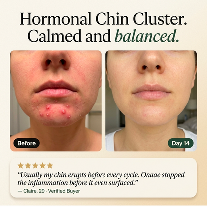 Hormonal Acne Defense Concentrate™