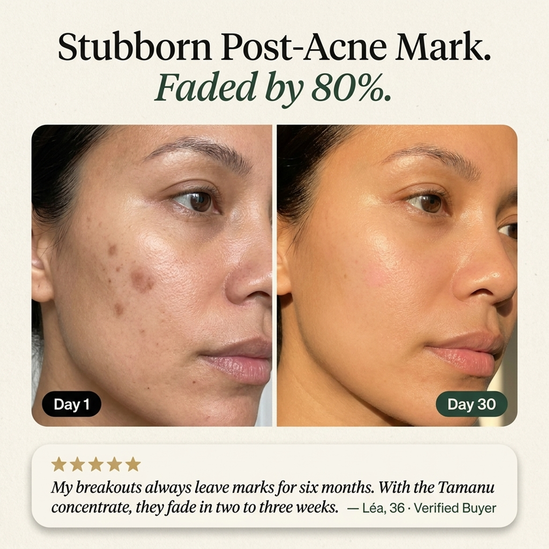 Hormonal Acne Defense Concentrate™