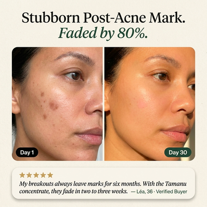 Hormonal Acne Defense Concentrate™