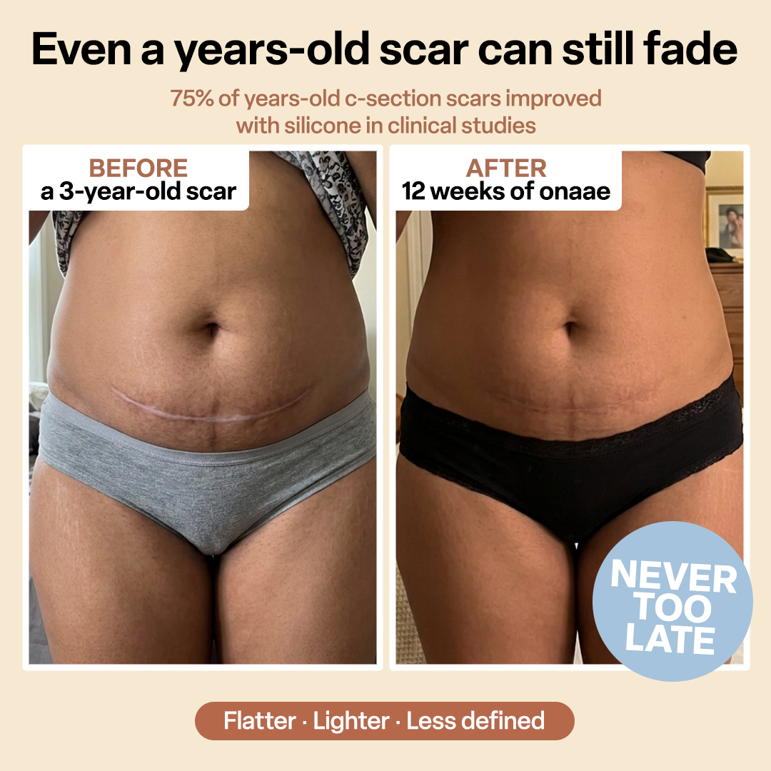C-Section Scar Recovery Stick™