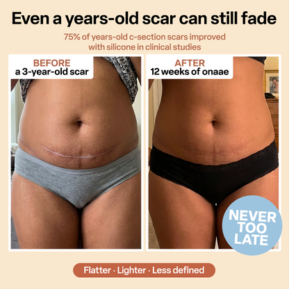 C-Section Scar Recovery Stick™
