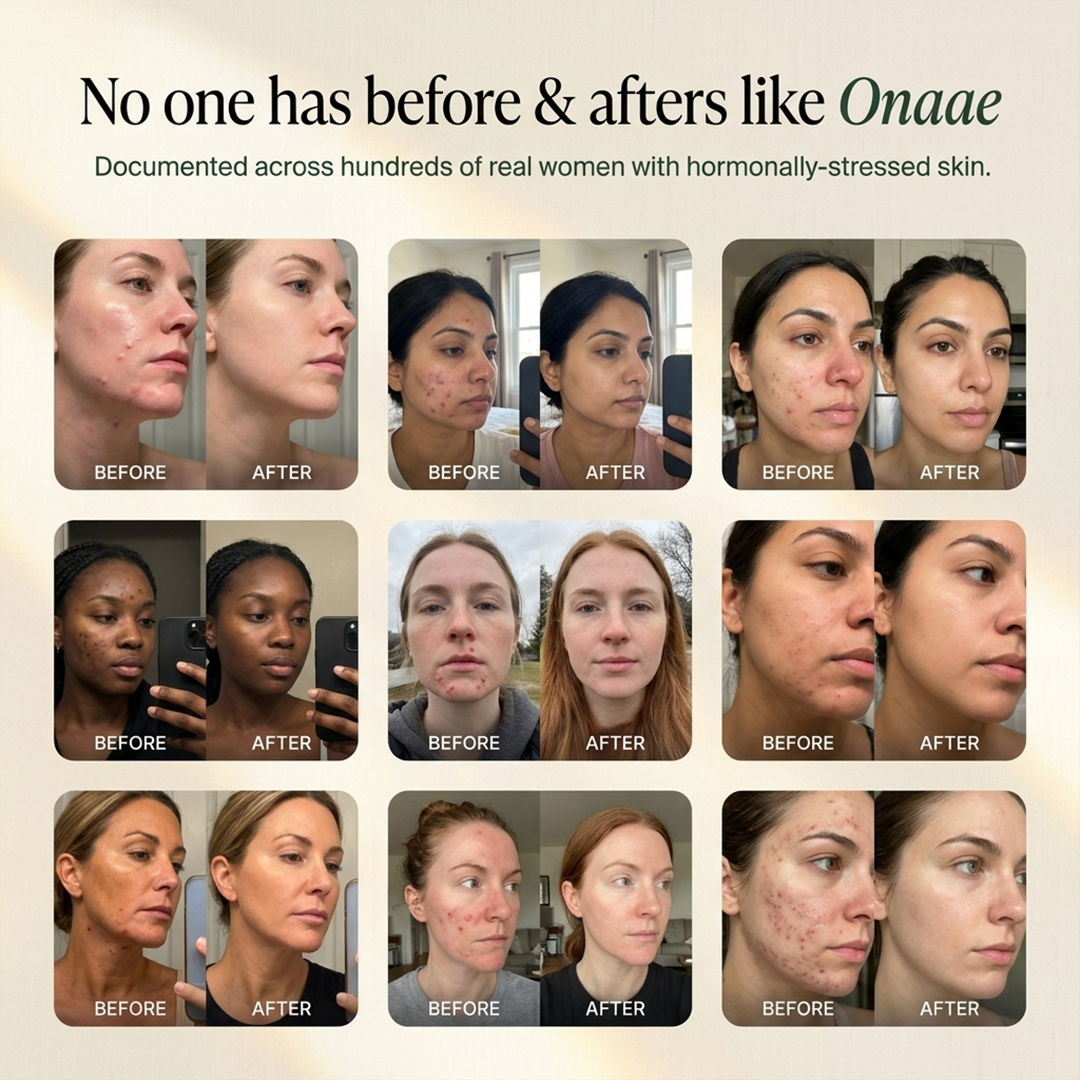 Hormonal Acne Defense Concentrate™