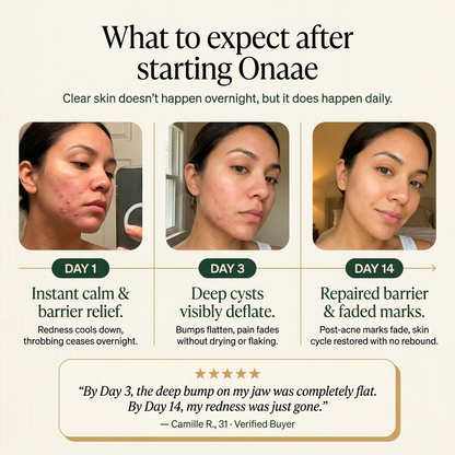 Hormonal Acne Defense Concentrate™